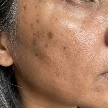 Dark spots and sun marks