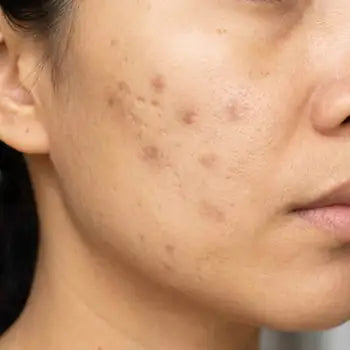 Post-acne marks