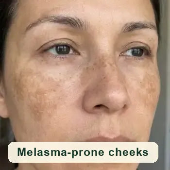 Melasma-prone cheeks