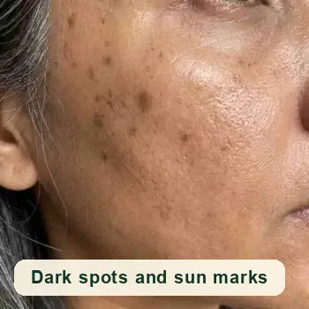 Dark spots and sun marks