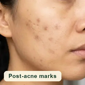 Post-acne marks