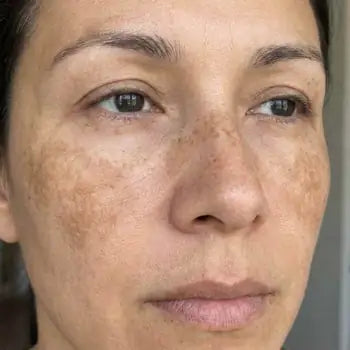 Melasma-prone cheeks